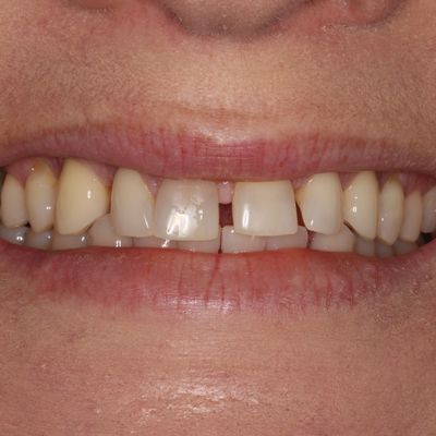 Composite Bonding - Smile 6 before